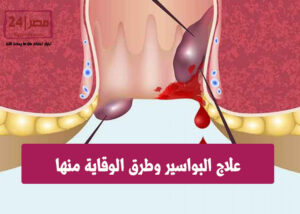 علاج البواسير وطرق الوقاية منها