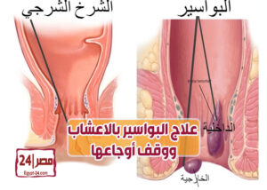 مرهم لعلاج البواسير, علاج البواسير نهائيا, ماهو علاج البواسير الخارجية عند النساء, علاج البواسير الخارجية المنتفخة, علاج البواسير الحجري, علاج البواسير في يوم واحد, عايزه علاج البواسير, علاج للبواسير الملتهبة, علاج للبواسير الملتهبة, التخلص من البواسير في دقيقتين, علاج البواسير بالثوم, ماهو علاج البواسير الخارجية عند النساء, علاج البواسير في يوم واحد,, علاج البواسير بالفازلين, علاج البواسير نهائيا, علاج البواسير الخارجية المنتفخة,