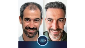 نتائج قبل وبعد زراعة الشعر في تركيا