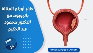 علاج أورام المثانة بالروبوت مع الدكتور محمود عبد الحكيم